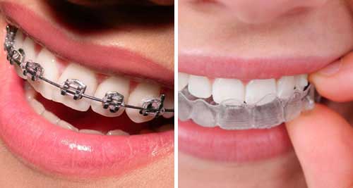 medi-cal-dental-coverage-does-it-cover-braces