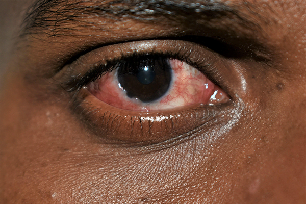 Conjunctivitis And Corneal Disease, optometrist Los Angeles CA